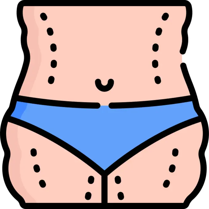 Liposuction